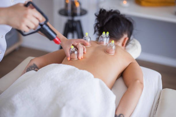 Glass cups placed on a client’s back during a traditional cupping therapy session